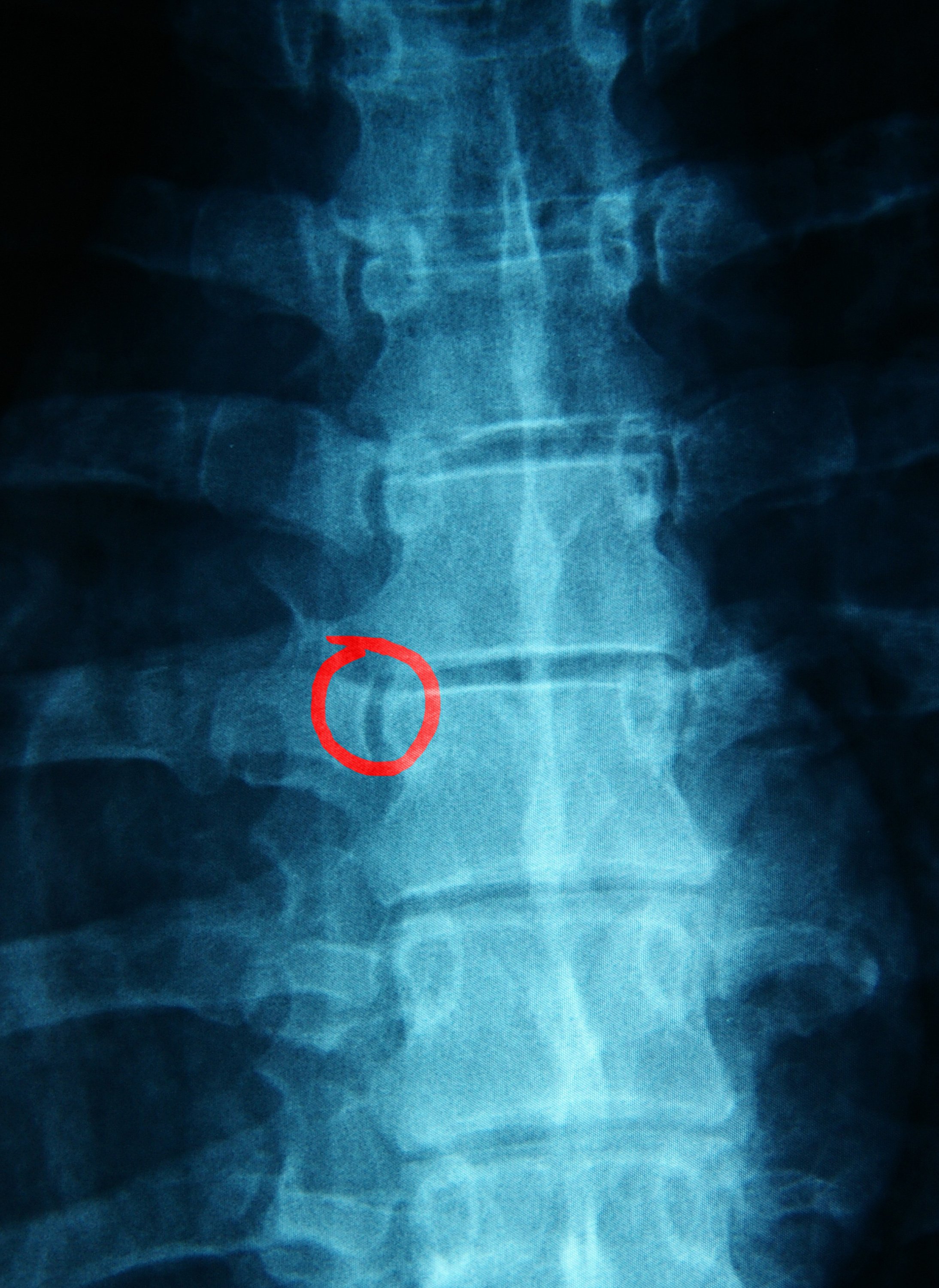 Radiografía de columna humana con zona marcada en rojo indicando dolor lumbar