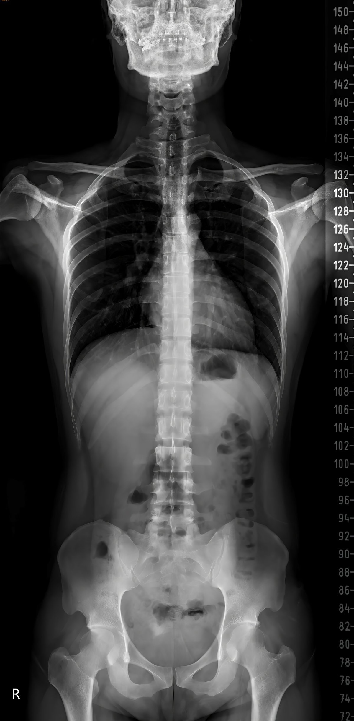 X-ray of whole spine in dark background with calibrate tool.