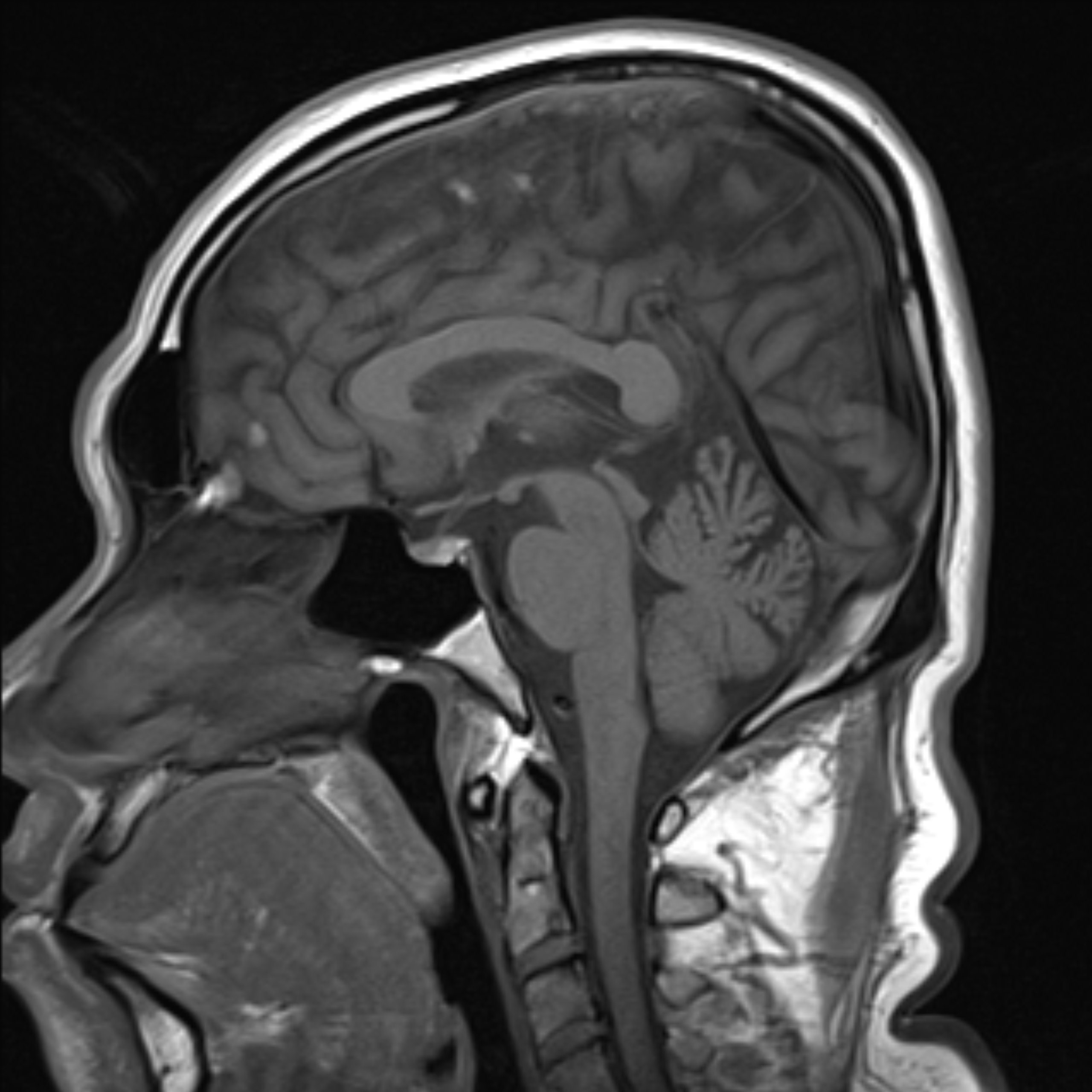 Imagen de resonancia magnética cerebral en planos axial, sagital y coronal
