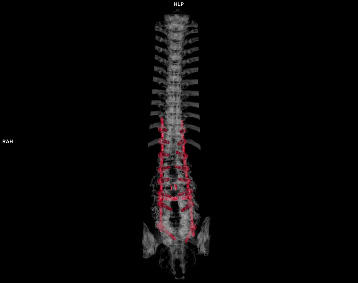 CT scan of thoracic and lumbar spine 3d rendering showing pedicle screw implant after surgical decompression and spinal fusion.