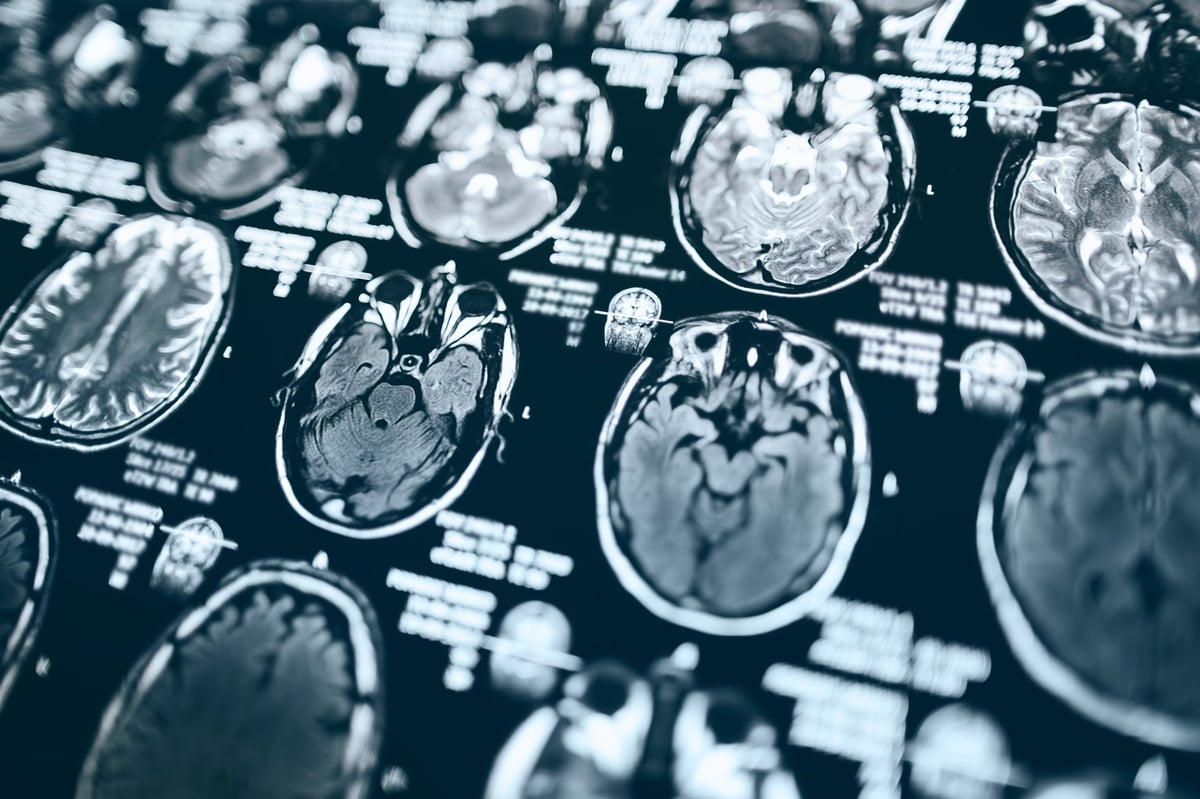 MRI head scan, magnetic resonance imaging of head showing neurological structures