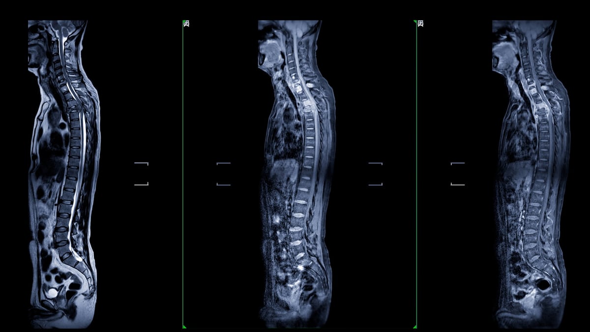 MRI of whole spine image showing comprehensive detail of entire spinal structure