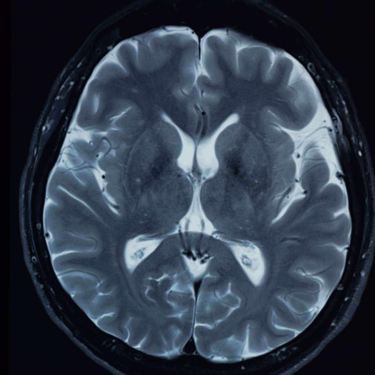 Resonancia magnética cerebral ponderada en T2 que muestra las meninges y el tejido cerebral donde se evalúa la diseminación de células tumorales en la carcinomatosis meníngea