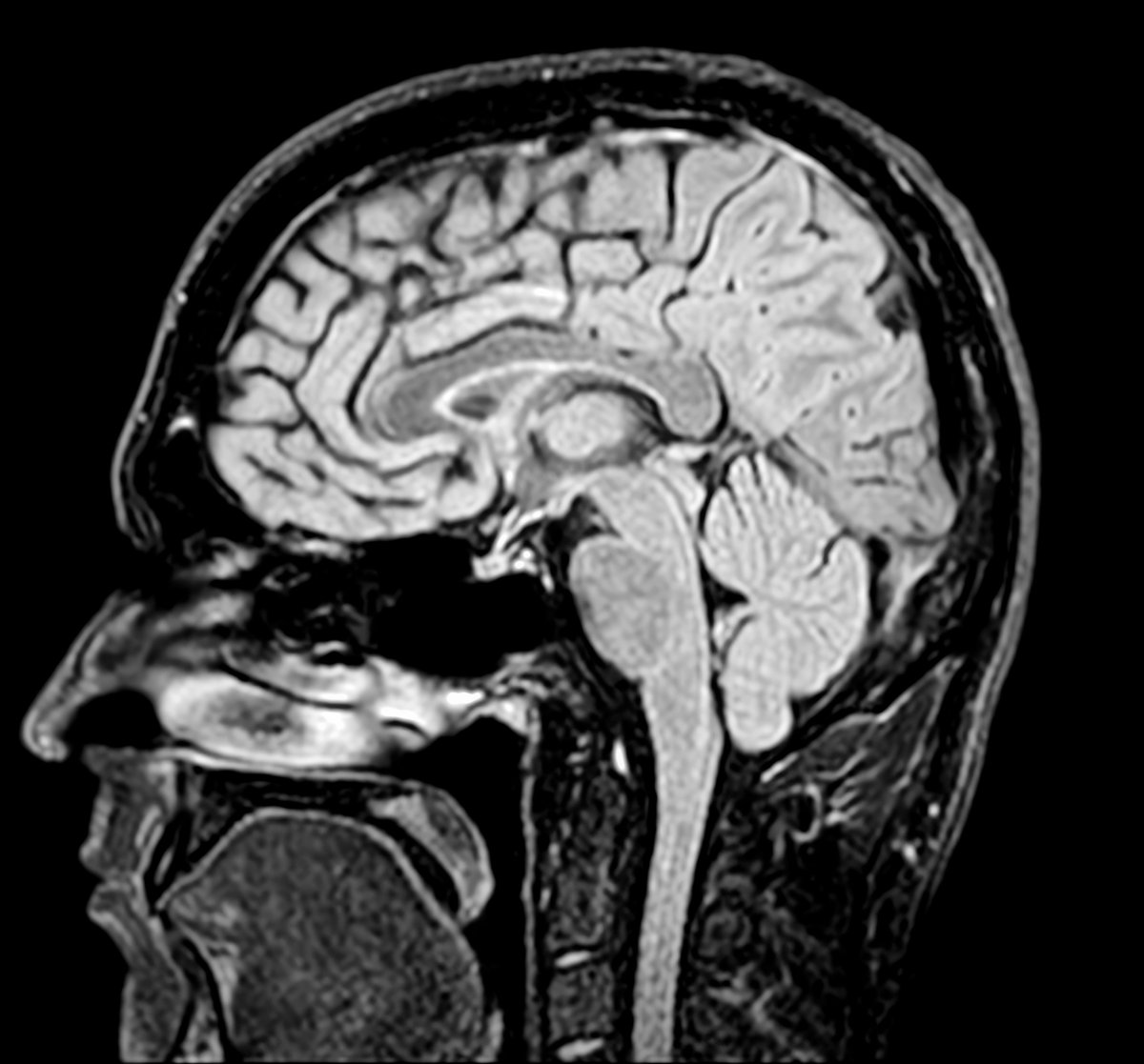 Resonancia magnética cerebral sagital de alta resolución que muestra la anatomía del cerebro donde se detectan los quistes aracnoideos llenos de líquido cefalorraquídeo, utilizada en diagnóstico neuroquirúrgico en CDMX