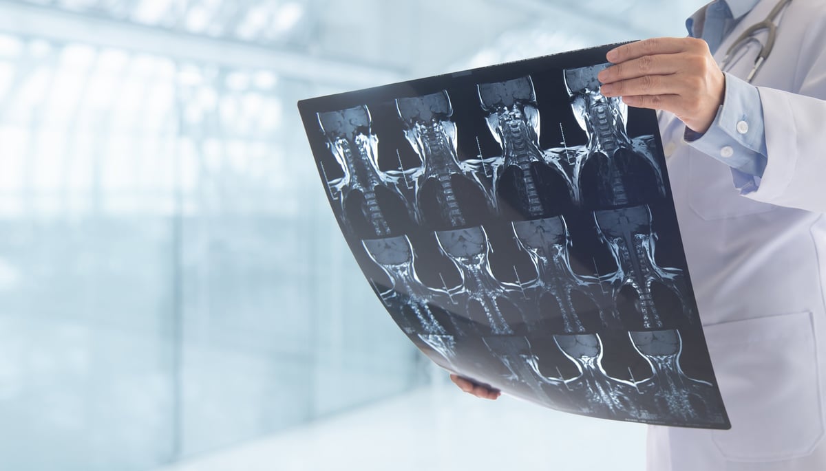 Tomografía computarizada y resonancia magnética de columna cervical con osteoartritis, estudios de imagen utilizados para planificar una cirugía de revisión de columna en CDMX