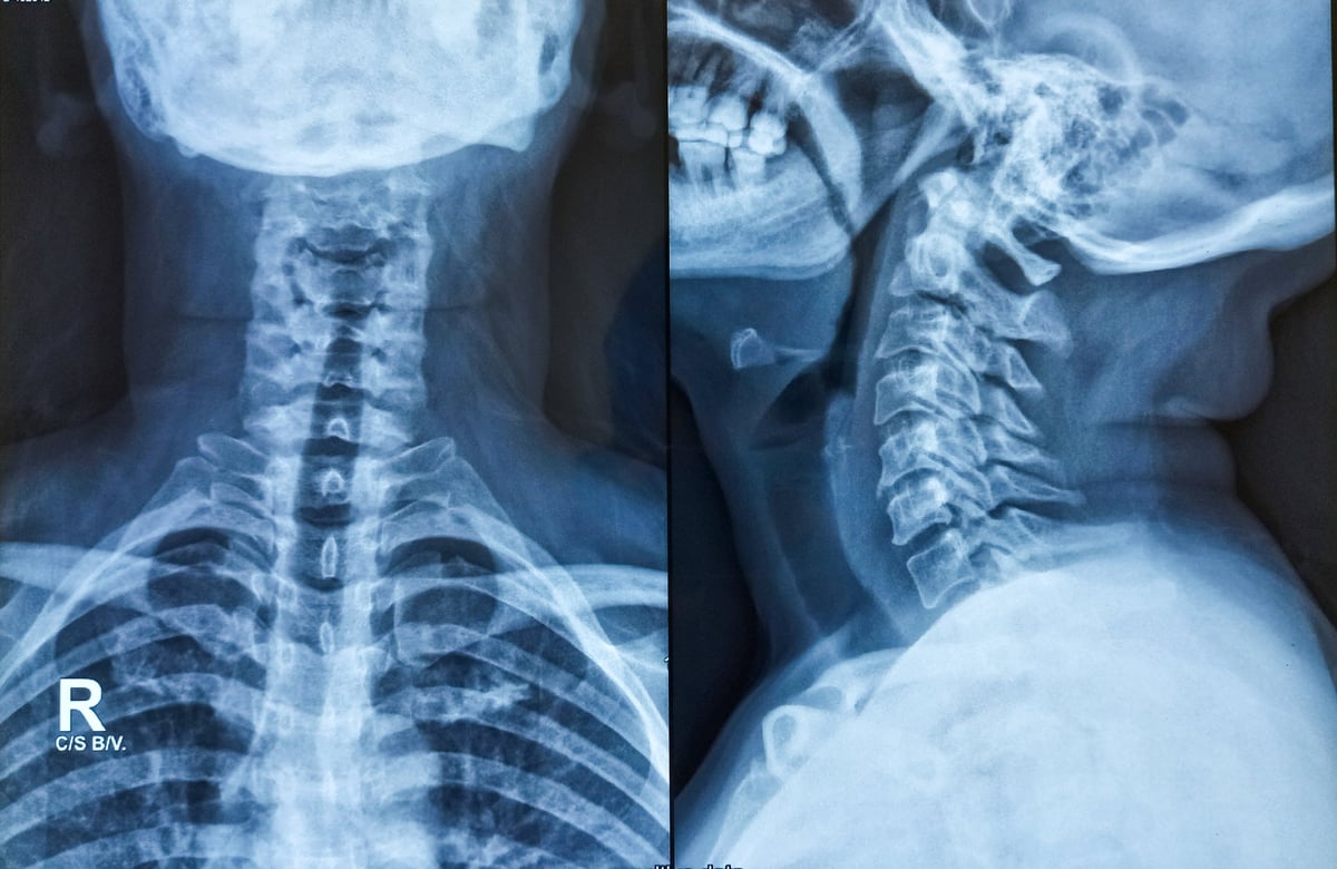 Radiografía de columna cervical que muestra cambios degenerativos tempranos y osteofitos marginales en las vértebras, hallazgos que pueden contribuir al síndrome de piernas inquietas de causa espinal