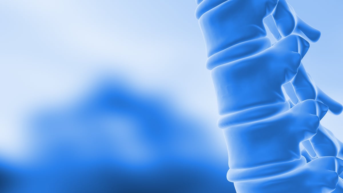 Imagen de fractura en cuña vertebral o fractura por compresión donde el frente de la vértebra colapsa, complicación frecuente en la espondiloartritis con columna rígida en Toluca
