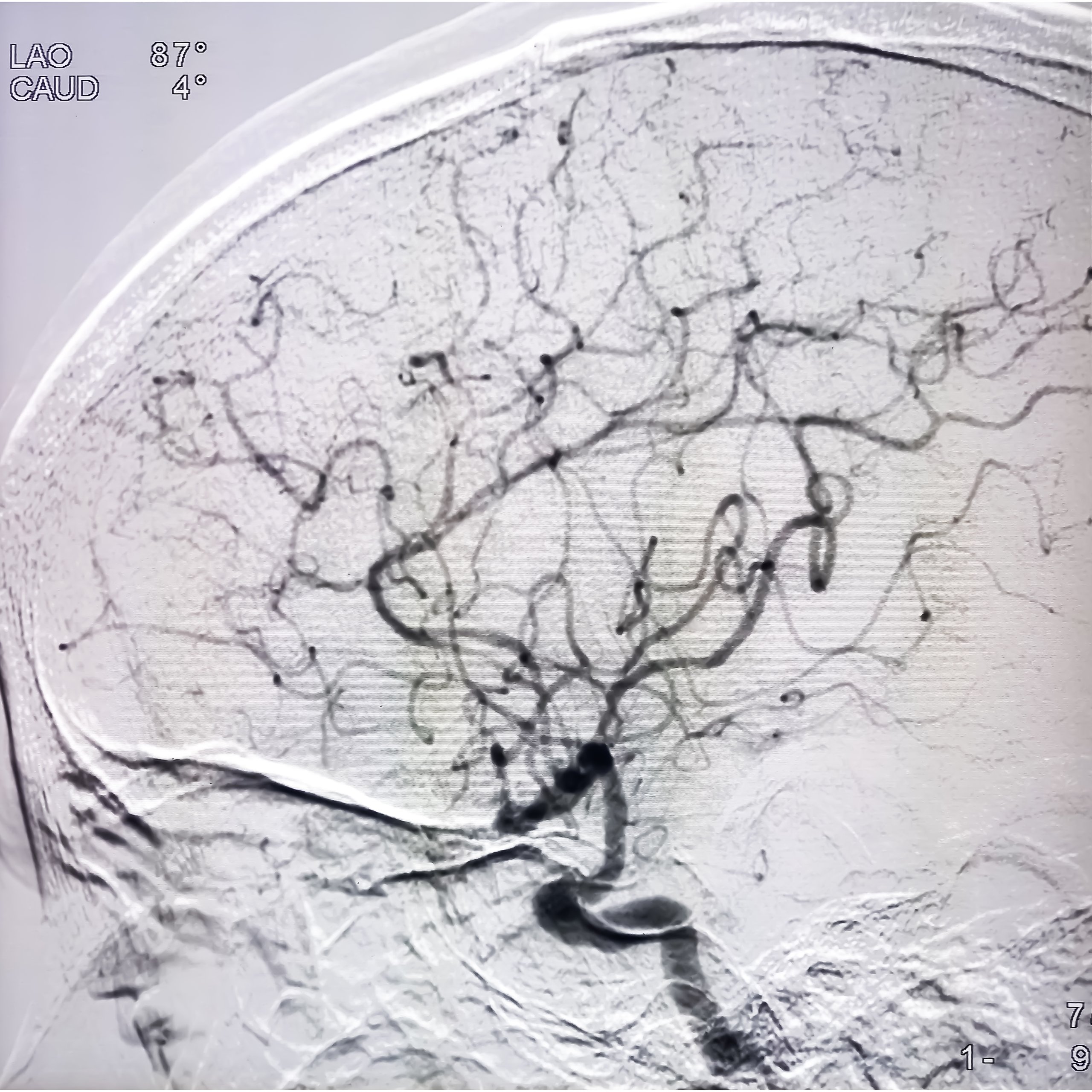 Angiografía cerebral por sustracción digital mostrando vasos sanguíneos del cerebro