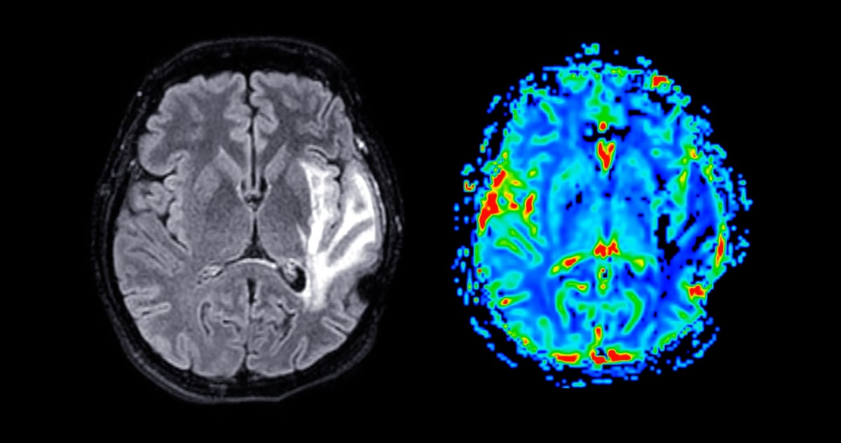 MRI brain perfusion imaging helps assess cerebral blood flow and tissue viability