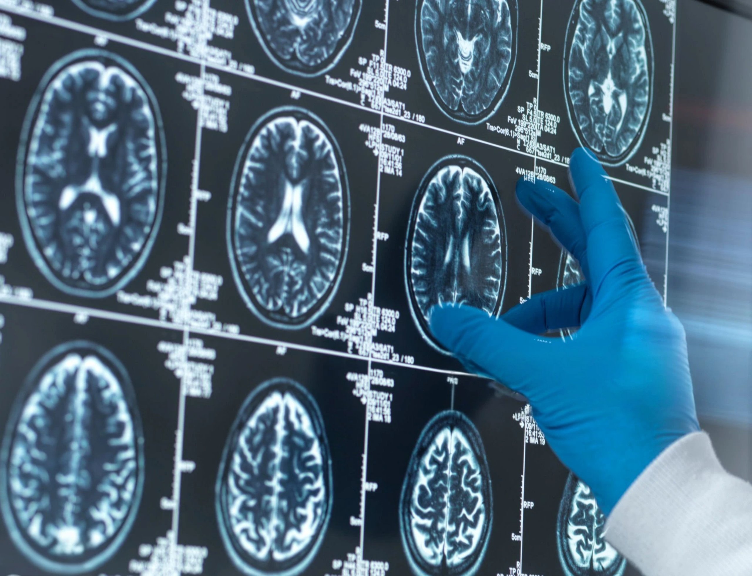 Médico señalando resonancia magnética cerebral mostrando estructuras vasculares
