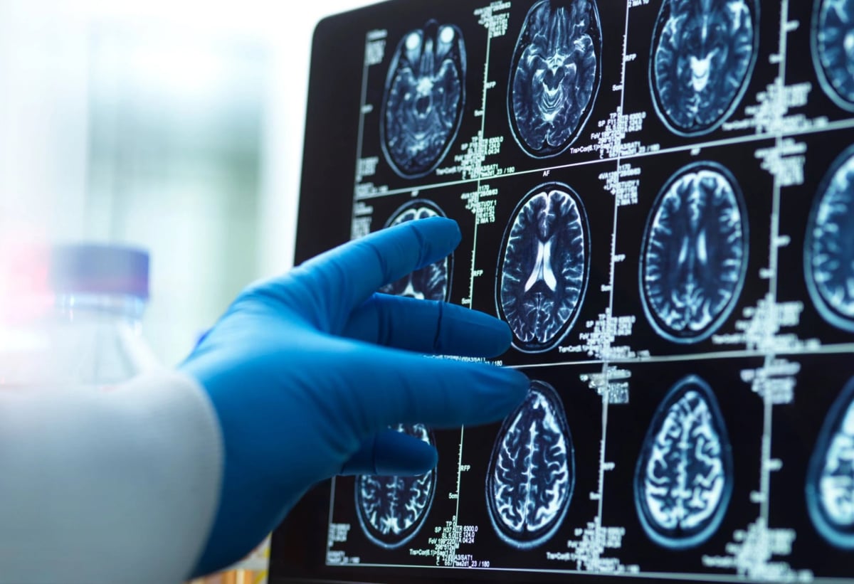 A doctor's hand in a surgical glove pointing at a brain scan image on a computer screen