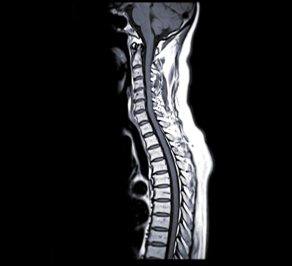 Resonancia magnética de columna cervical mostrando la médula espinal y estructuras vertebrales