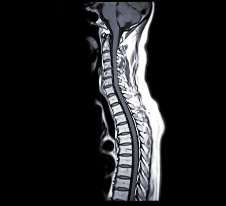 Resonancia magnética de columna cervical