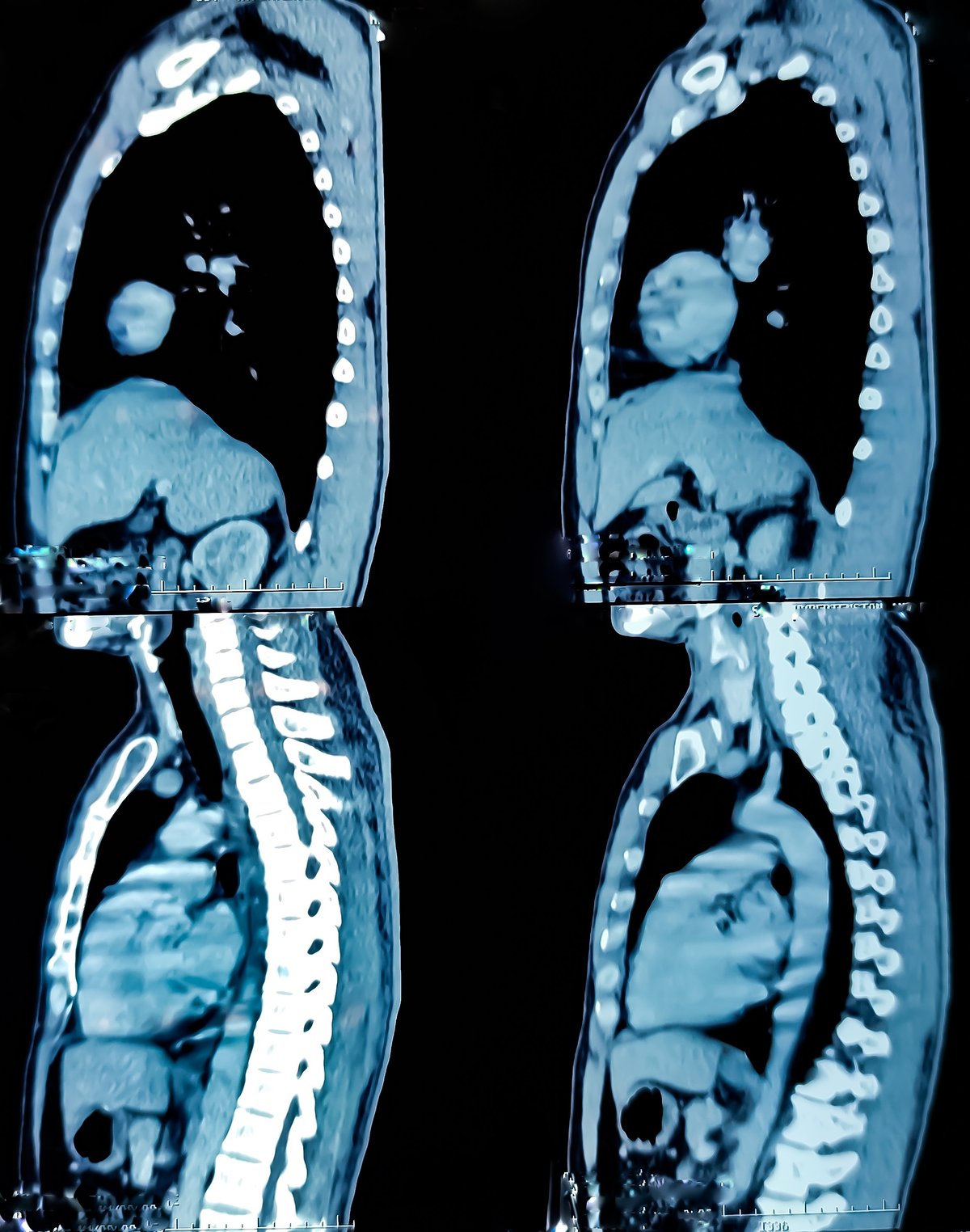 CT Scan of Chest showing pleural based mass lesion for evaluation of metastasis