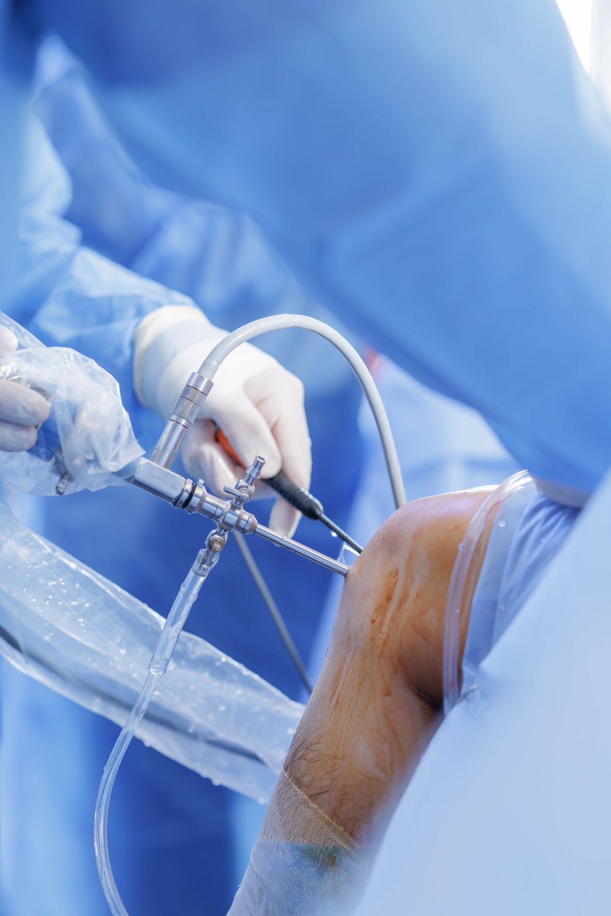 Close view of minimally invasive surgery with arthroscope and cannulas on blue sterile drapes