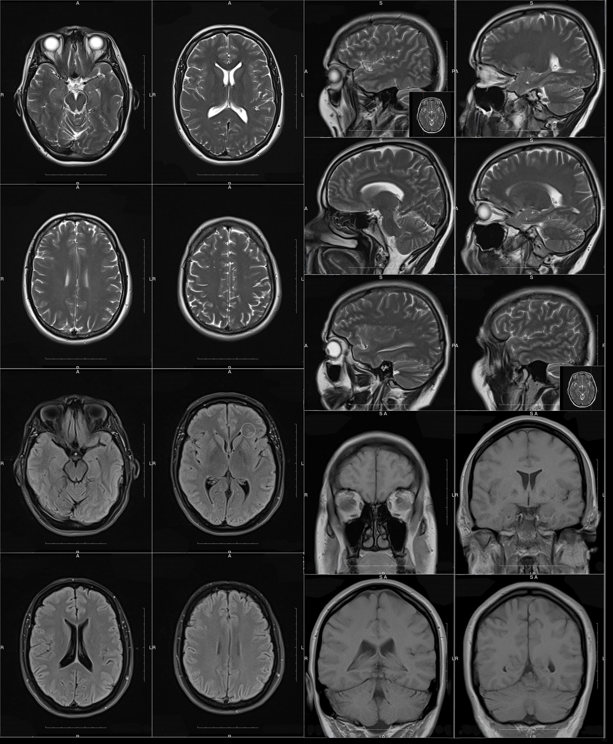 Resonancia magnética cerebral mostrando cortes detallados de la cabeza y estructura cerebral
