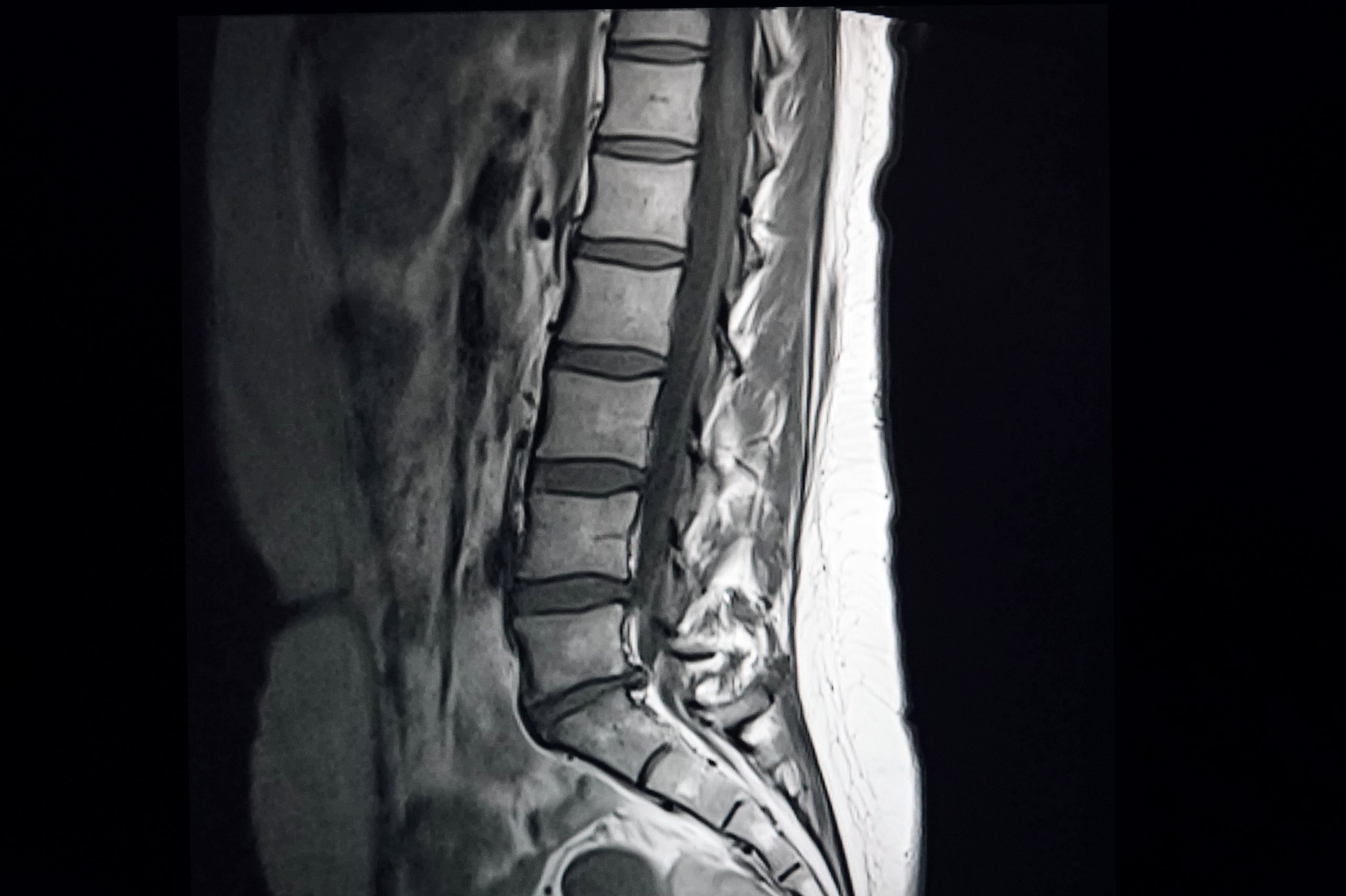 Resonancia magnética de columna lumbar en proyección sagital mostrando estructura espinal