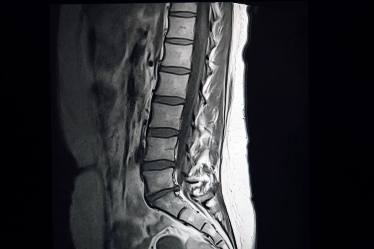 Resonancia magnética de columna lumbar en proyección sagital mostrando cuerpos vertebrales, discos intervertebrales y canal espinal