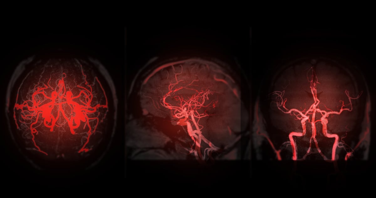 Resonancia magnética y angiografía cerebral en vistas axial, sagital y coronal, estudios de neuroimagen utilizados para evaluar indicación quirúrgica en adultos mayores de 75 años en CDMX