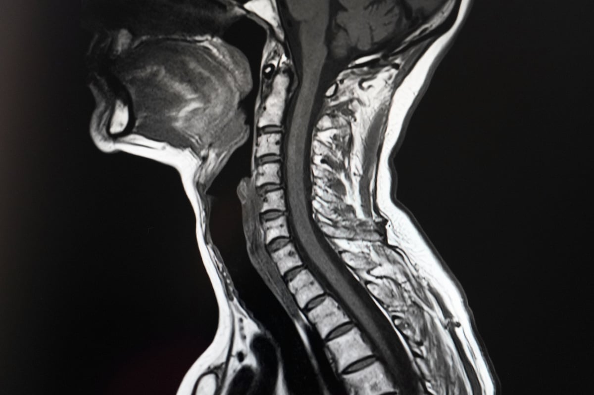 Resonancia magnética de columna vertebral en proyección sagital mostrando cambios degenerativos, altura discal y canal espinal