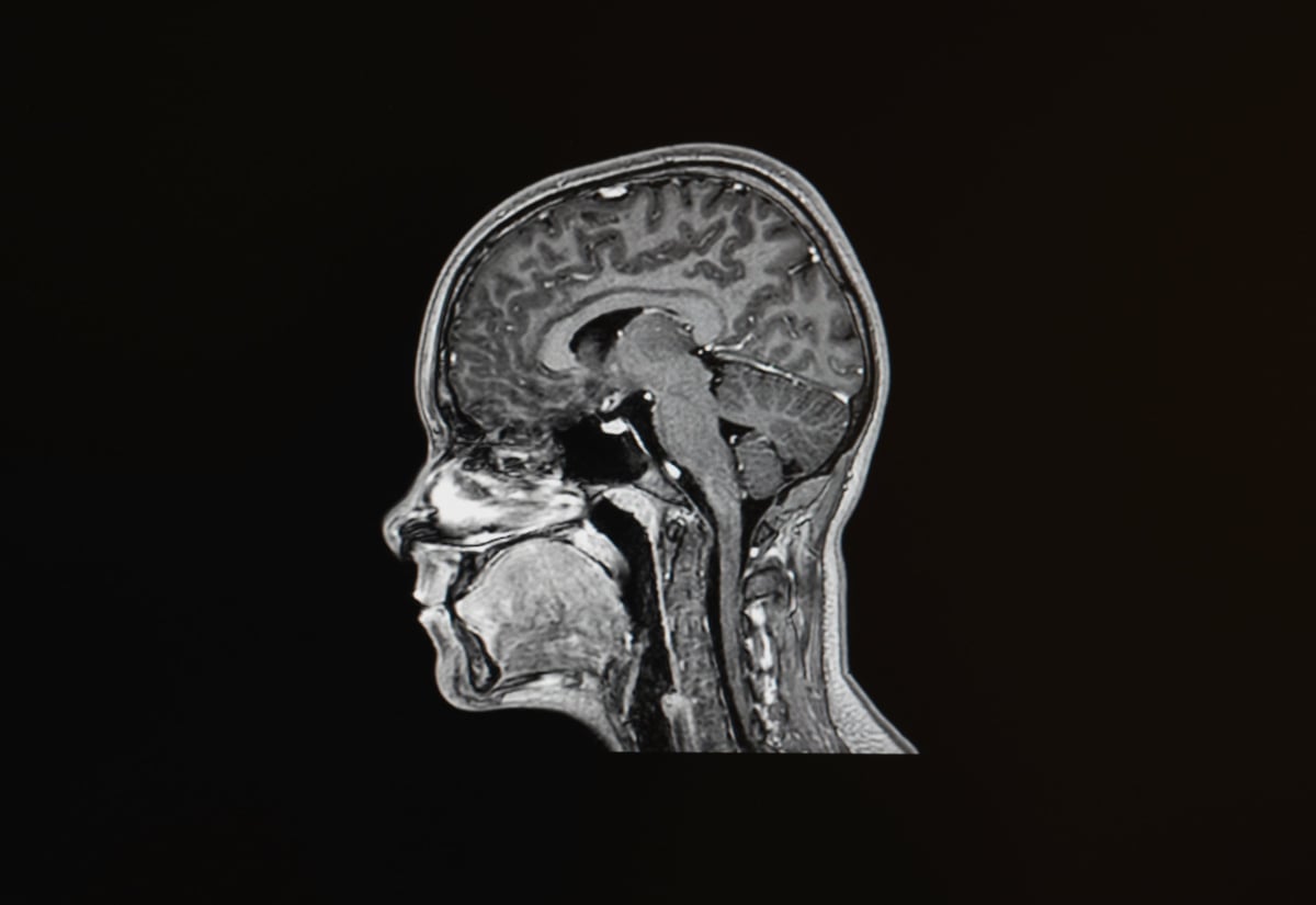Black and white brain MRI scan showing the fragility and power of human existence hidden beneath the skull