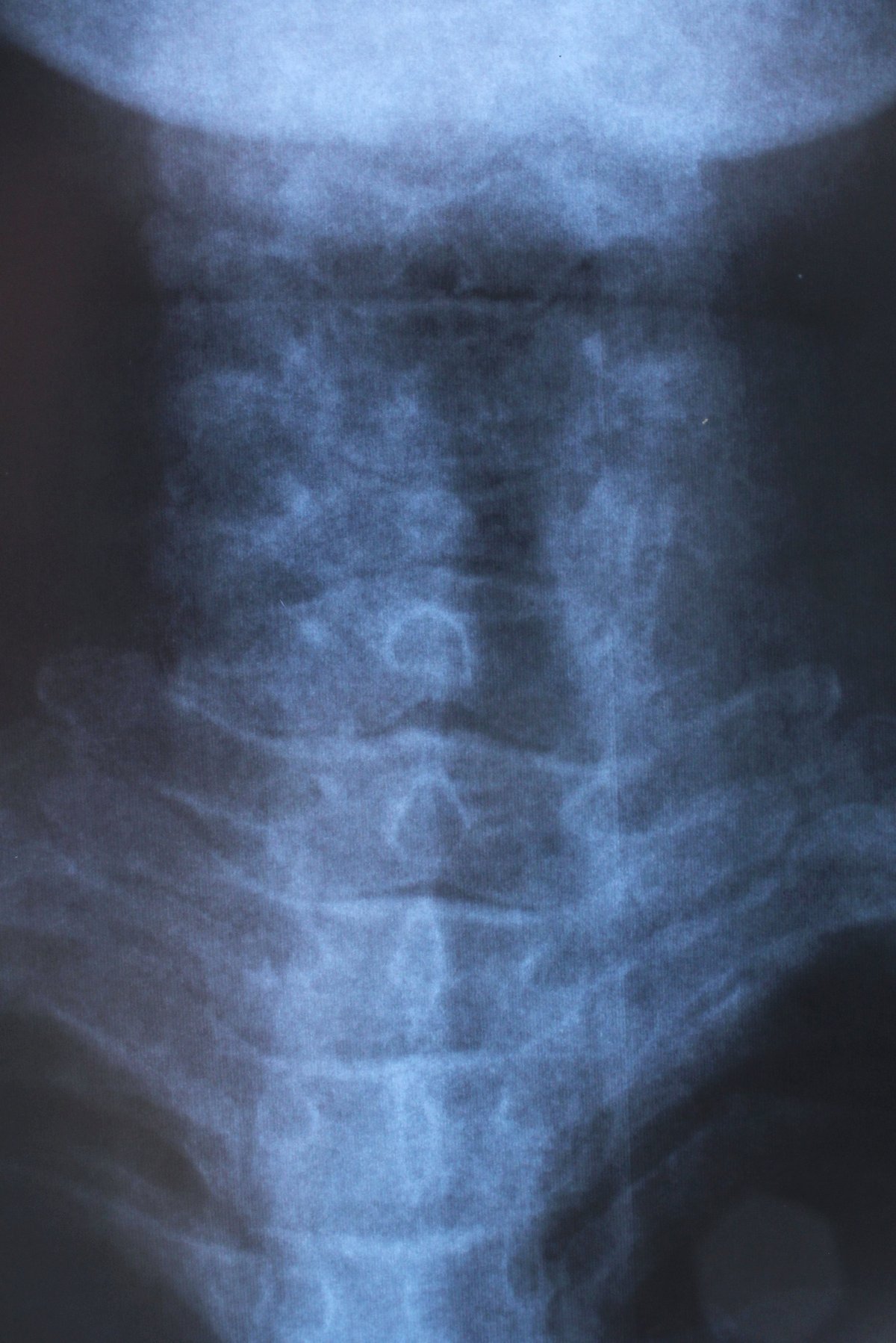 Radiografía de columna cervical en proyección anteroposterior mostrando la estructura de las vértebras del cuello