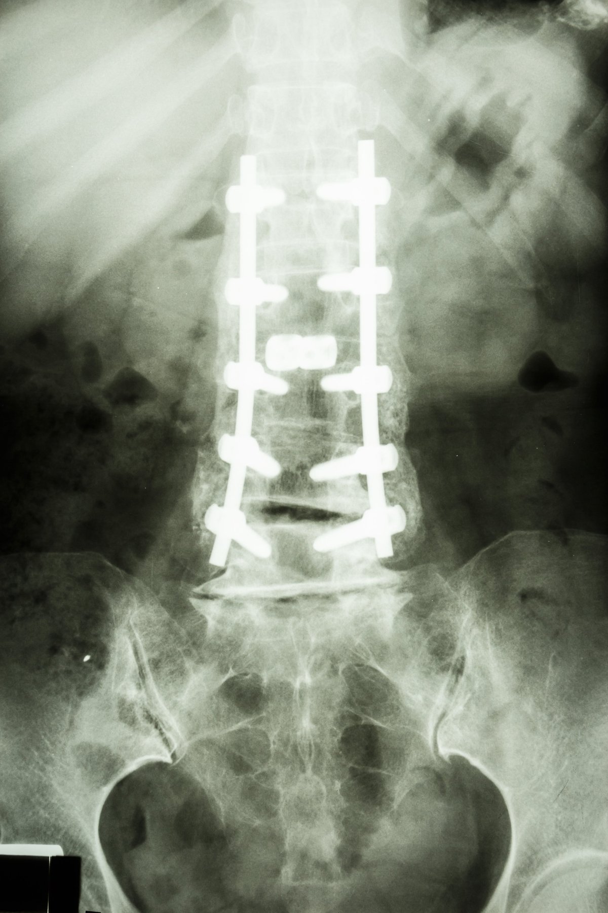film X-ray show lumbar spine with pedicle screw fixation in spondylolisthesis patient